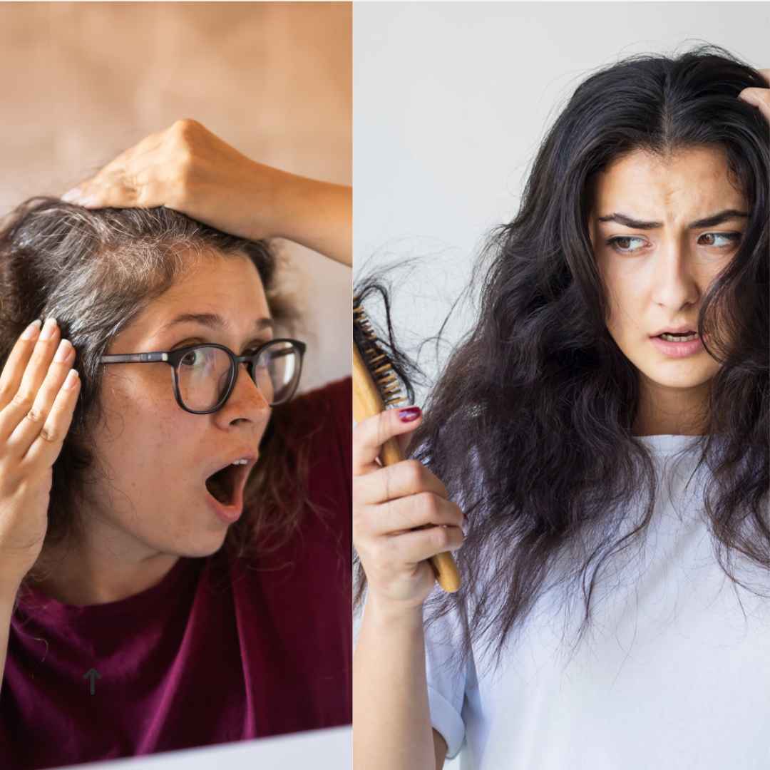 Severe Hairfall